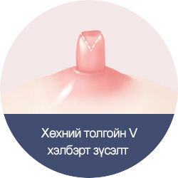 Nipple V shape Incision